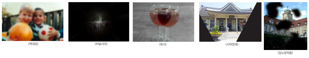 백내장, 터널시야,복시,시야장애,당뇨망막증 사진